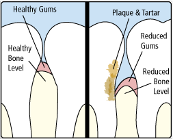 surrey gum disease example | Newton Village Dental Clinic