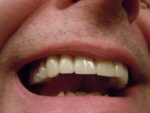 dental crowns in Surrey | Newton Village Dental Clinic