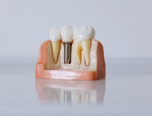 How To Care for Dental Implants
