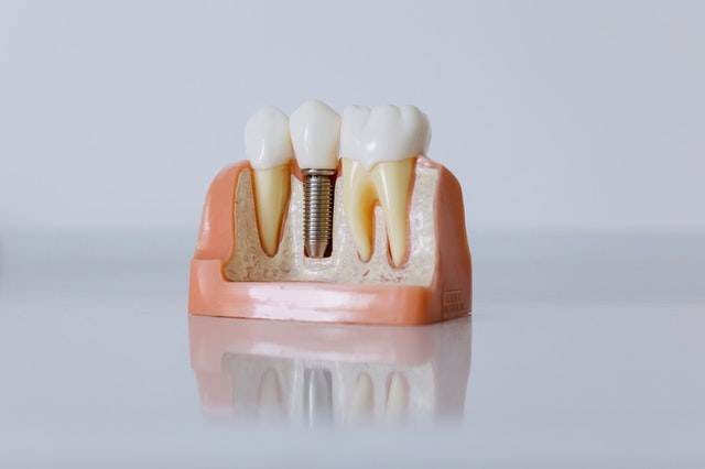 How To Care for Dental Implants | Newton Village Dental Clinic